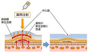 硝子体注射(抗VEGF薬注射)