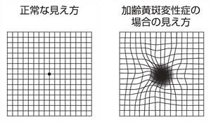 加齢黄斑変性症の自己チェック